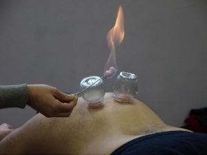 Tecnica di coppettazione Báguàn 拔罐 3